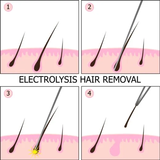 永久性电针脱毛、针脱毛、电解脱毛